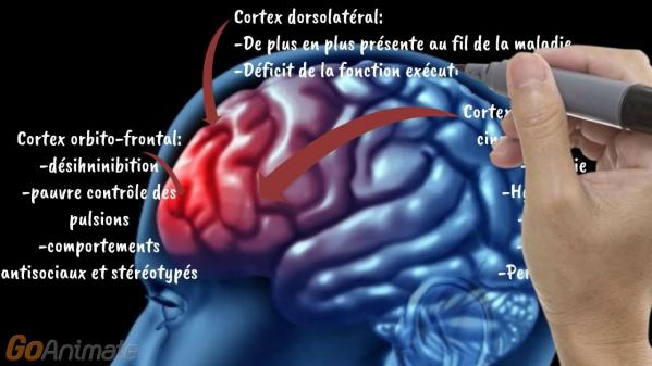 La demence du cerveau seniors